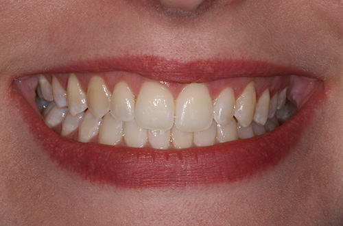 Smiling mouth showing straight and aligned teeth